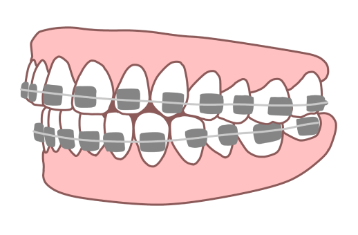 マルチブラケット装置（メタル）