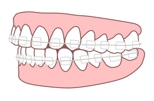 審美ブラケット装置